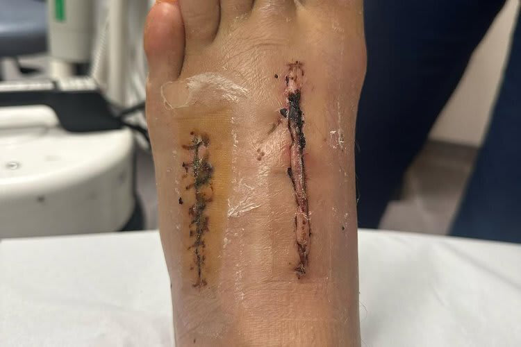 Die Ärzte hatten in Johnny Reas Fuß viel zu reparieren