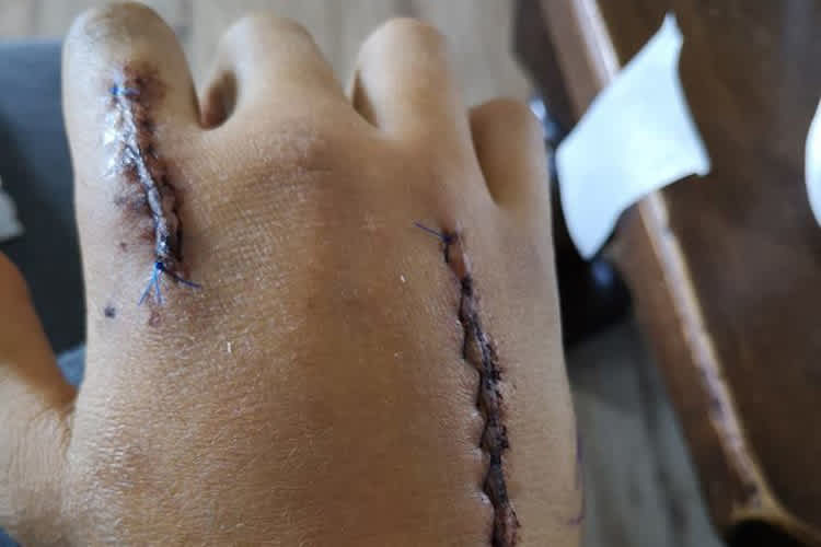 Dominic Schmitters Hand ist schwer lädiert