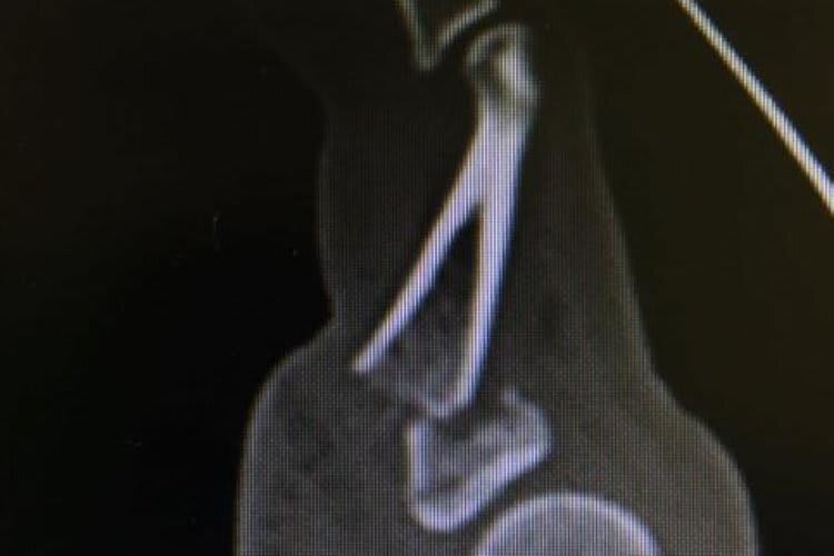 Der veschobene Bruch am kleinen Finger sieht schmerzhaft aus