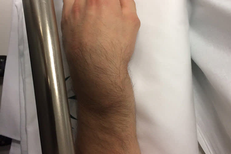 So sah der Unterarm von Eugene Laverty vor der Operation am Freitag aus