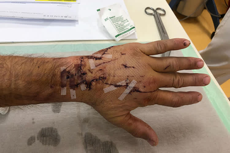 Franz Zorns Hand nach dem Sturz