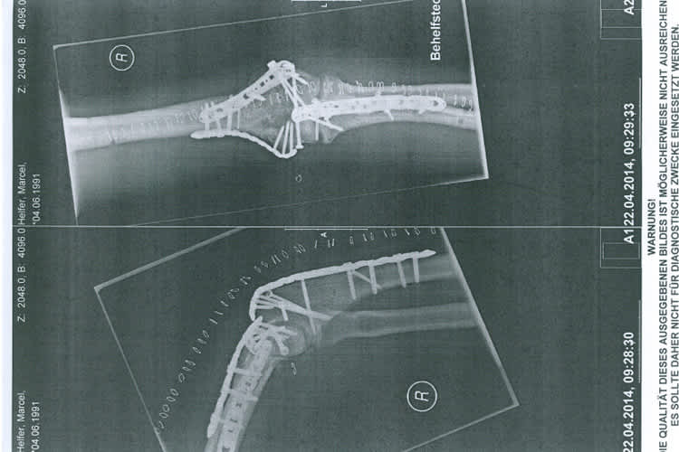 Drei Metallplatten und 20 Schrauben waren nötig, um den Arm zu richten
