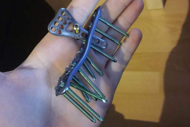 Philipp Öttl zeigt, wie viel Metall in seinem Arm steckte