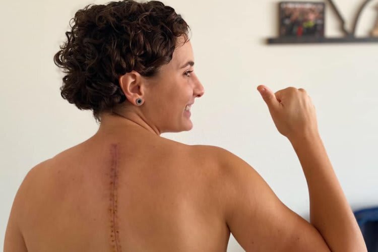 Ana Carrasco wird die Narbe lebenslang als Andenken an den Estoril-Sturz behalten