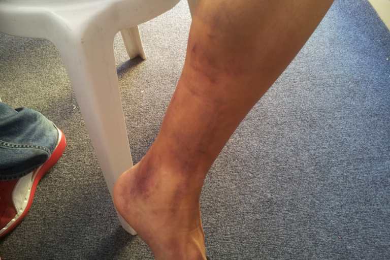 Das linke Bein von Ayrton Badovini