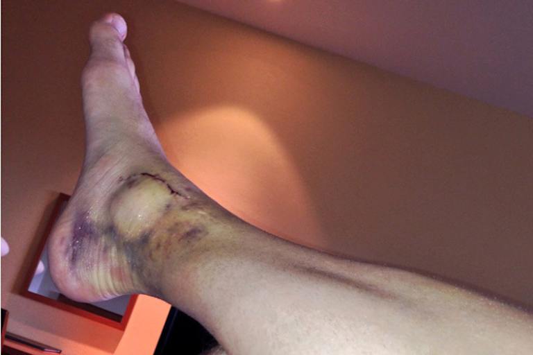 Stefan Bradl: Der rechte Knöchel schillert in allen Farben