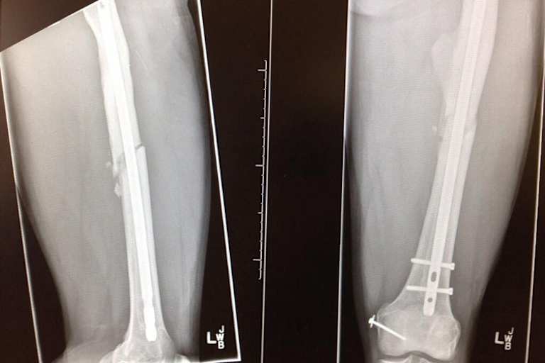 Reas linker Oberschenkel, fünf Wochen nach seinem Sturz