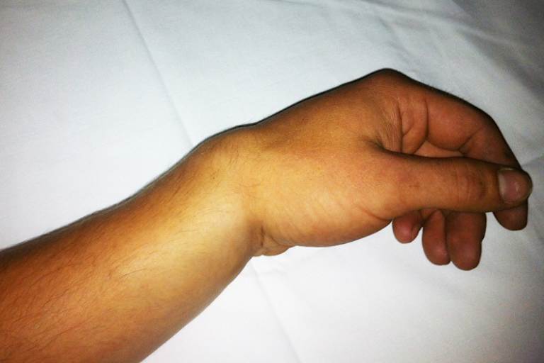 Im linken Handgelenk sind zwei Knochen gebrochen