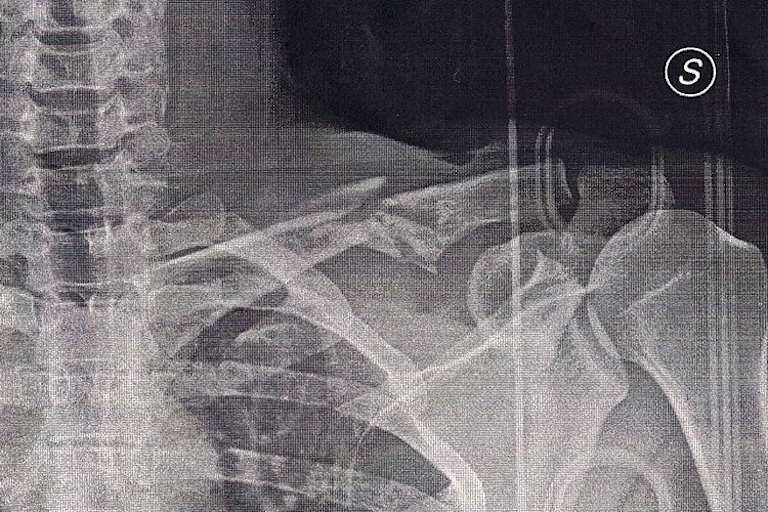 Das Röntgenbild zeigt die ganze Wahrheit