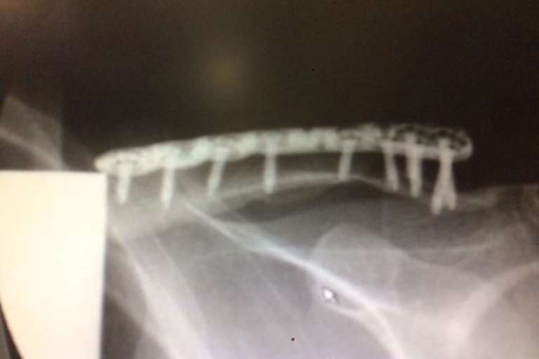 Eine Platte und Schrauben sind das Andenken vom Wintercross in Frankenbach