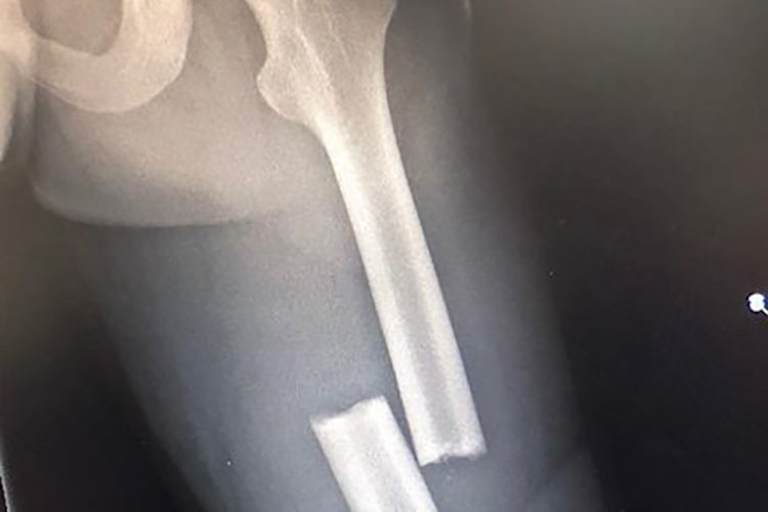 Der Bruch von Dupasquiers Oberschenkelknochen