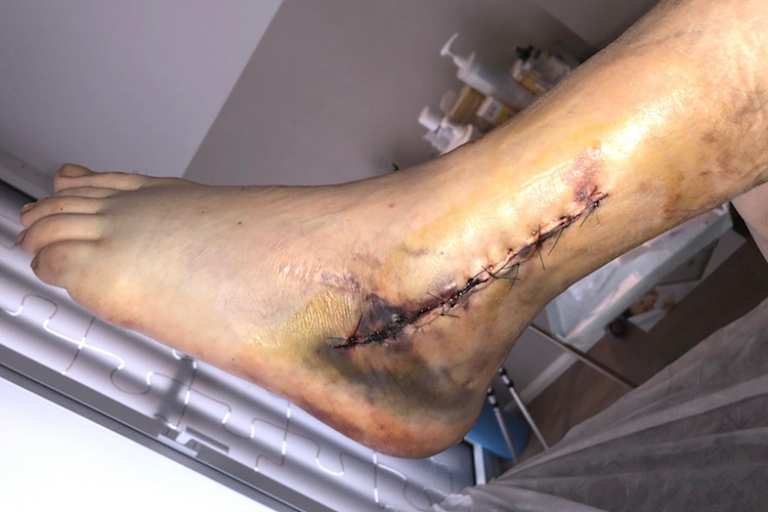 Der ehemalige GP-Pilot brachte Fotos von seinem linken Knöchel mit