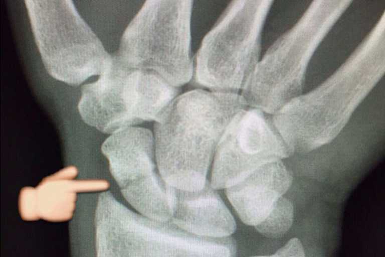 «Das Kahnbein ist genau in der Mitte gebrochen, das lässt sich gut operieren», hörte Stefan Bradl von den Ärzten