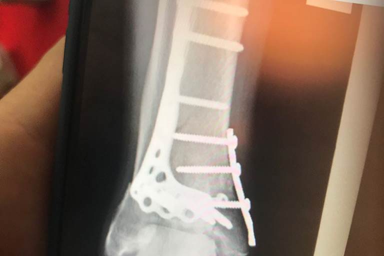 Der zerschmetterte rechte Knöchel von Cal Crutchlow