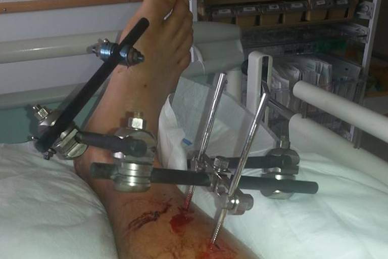 Der Fixateur ist schon wieder weg