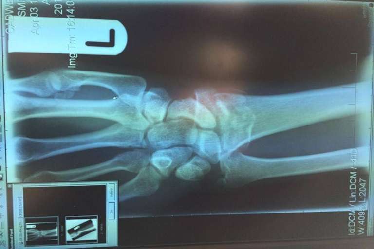 Röntgenbild des gerochenen Handgelenks