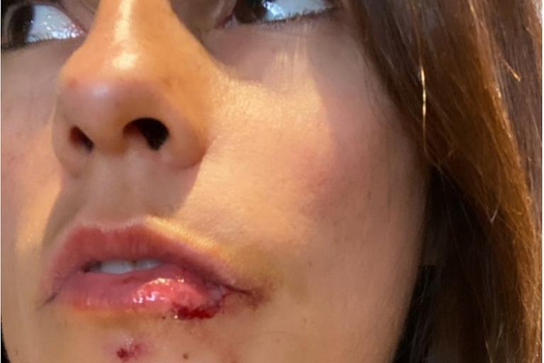 Der Zwischenfall auf der Skipiste hat seine Spuren hinterlassen