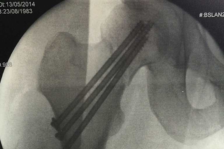 Drei Schrauben wurden Luca Scassa verpasst