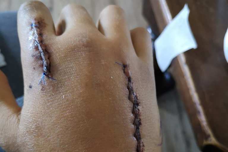 Schmitter verletzte Hand