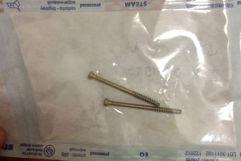 Diese zwei Schrauben wurden aus Dilgers Handgelenk entfernt