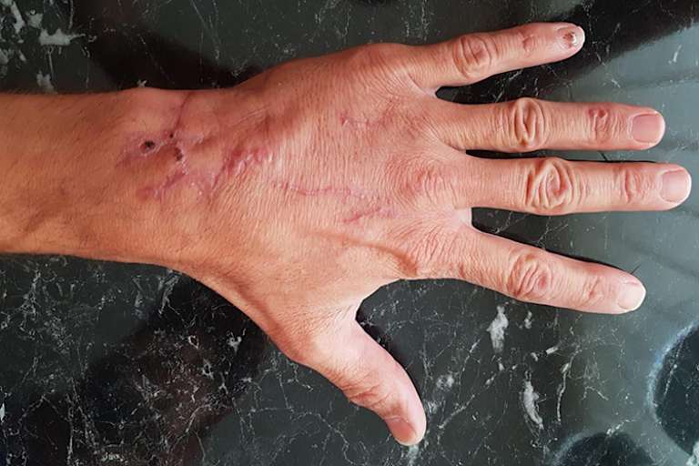 Inzwischen ist die Hand gut verheilt