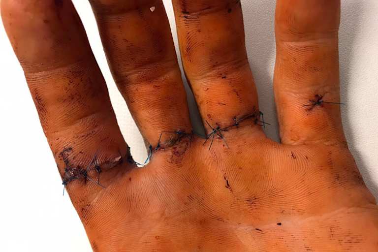 Nach der Operation sind Luca Schmidts Finger gerettet