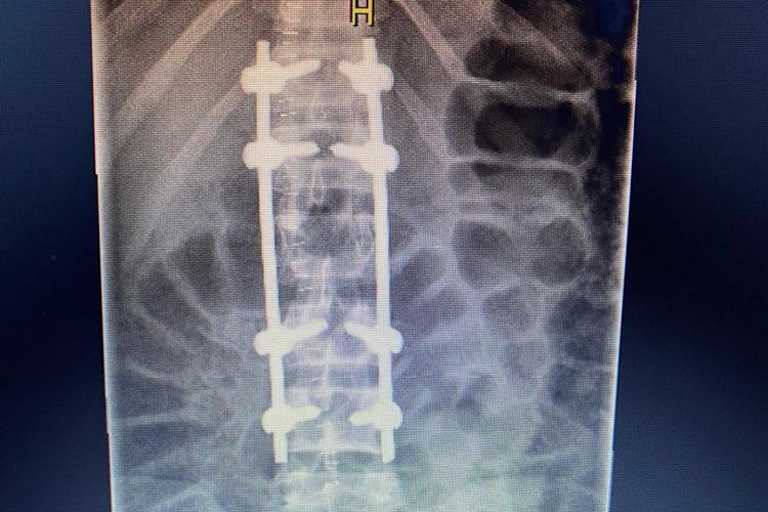 Ben Currie bekam viel Metall implantiert