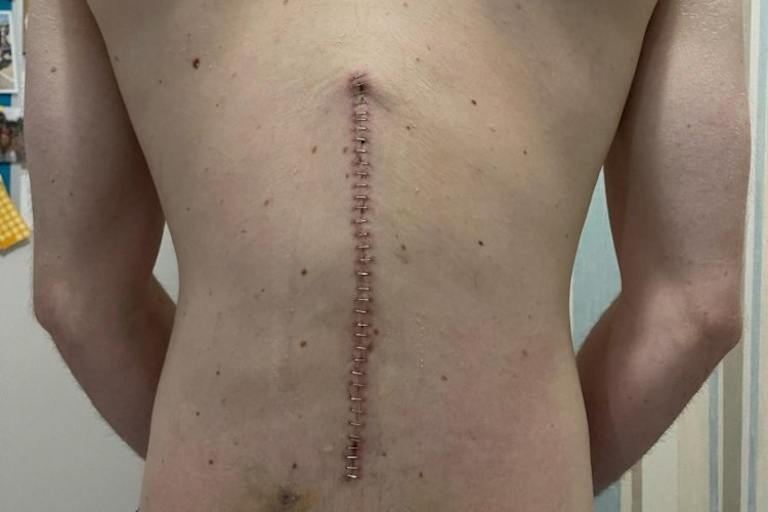 Eine lange Narbe ziert den Rücken von Ben Currie