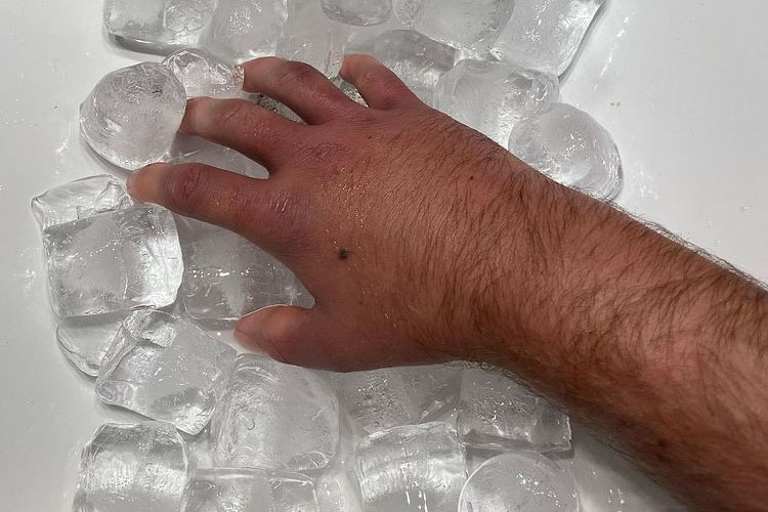 Immer noch stark geschwollen: rechte Hand von Sam Lowes