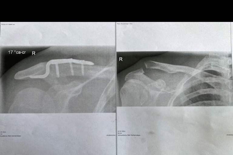 Die Schulter vorher und nachher