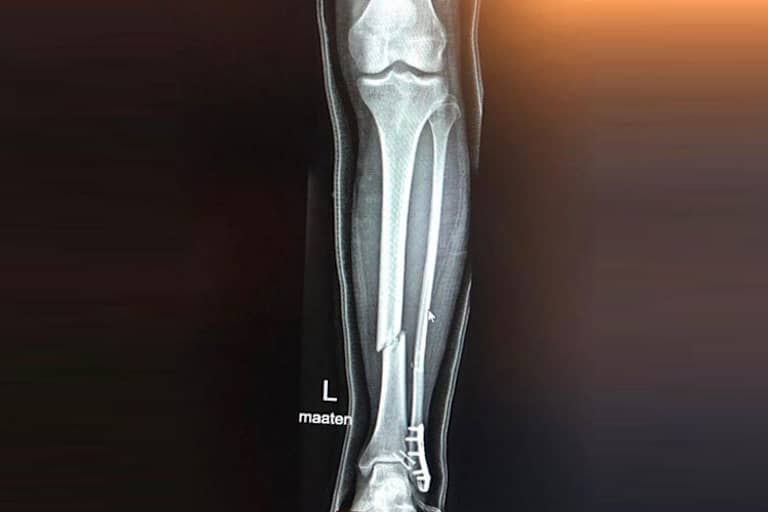 Schlimme Diagnose: Schien- und Wadenbein gebrochen