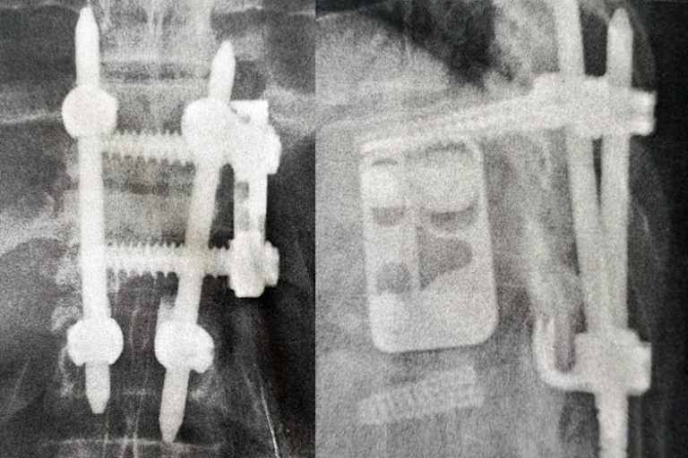 Innerer Wirbelsäulen-Fixateur