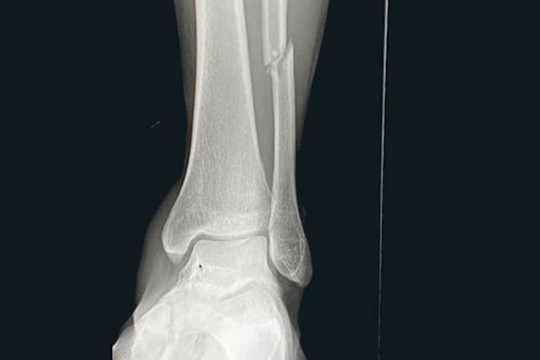 Das Wadenbein ist gebrochen