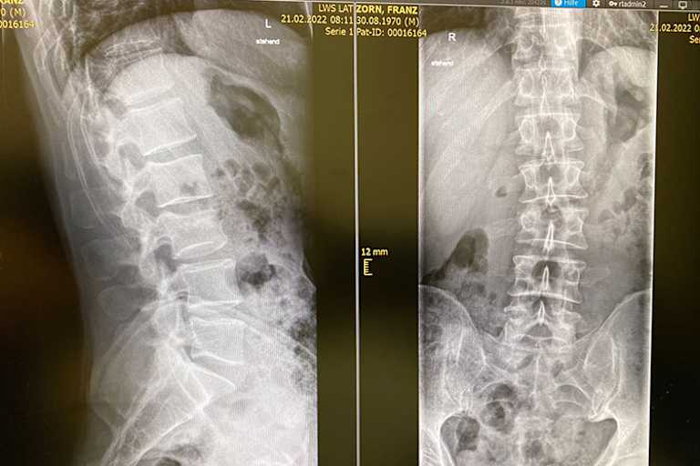 Der dritte Lendenwirbel ist gebrochen