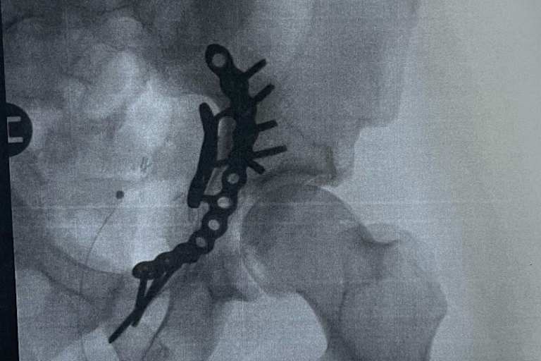 Die gebrochene Hüfte von Nicki Pedersen