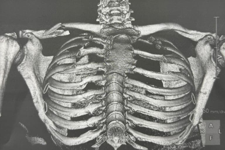 Die Röntgenaufnahme zeigt Martins gebrochenes Schlüsselbein