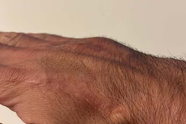 Die Schwellung auf der rechten Hand ist deutlich erkennbar