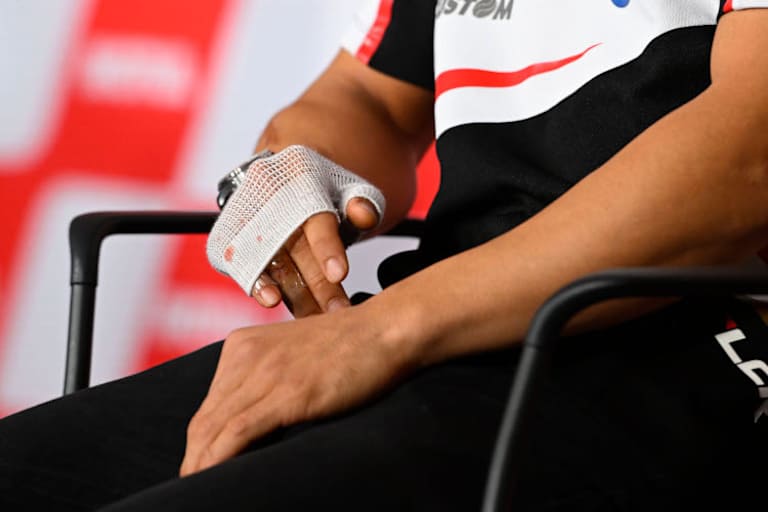 Nakagamis Finger drei Tage nach der OP