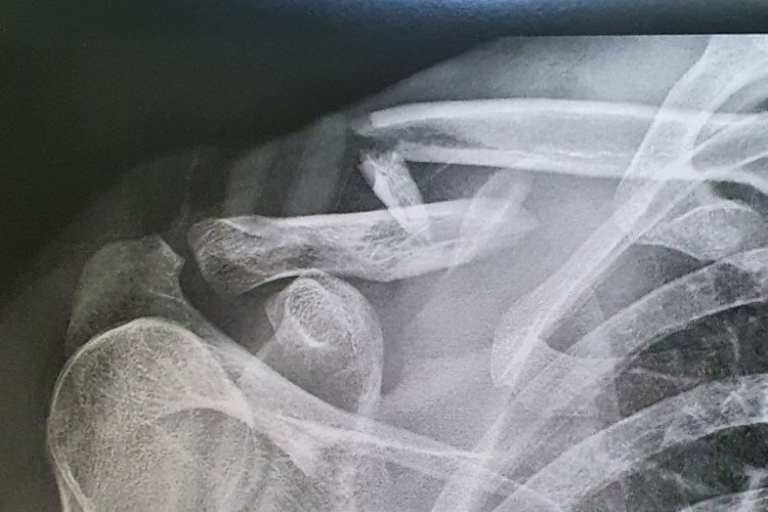 Die Knochenfragmente waren teils massiv verschoben