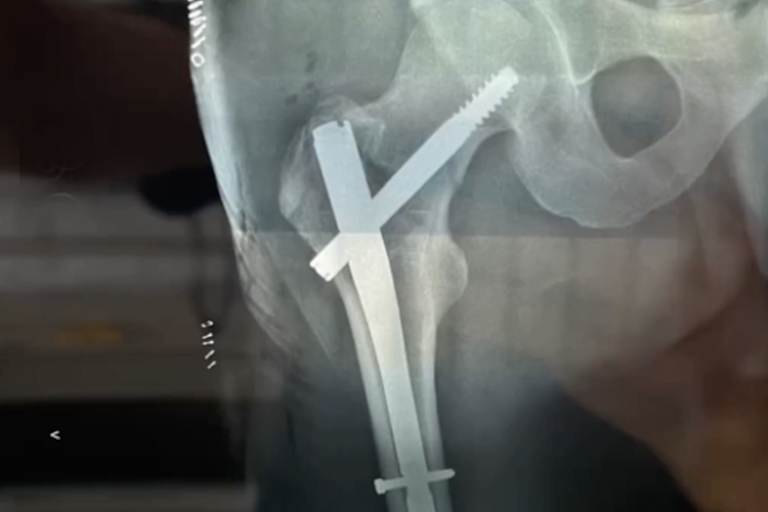 Das Hüftgelenk nach der Operation