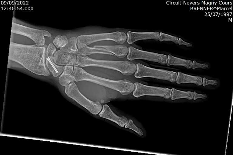 Der vierte Mittelhandknochen ist ab