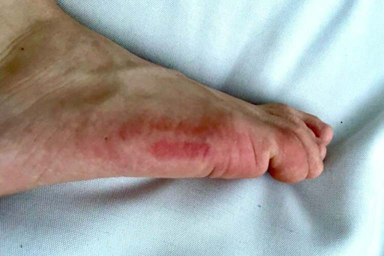 So sah der rechte Fuß von Stefan Bradl am Montag aus