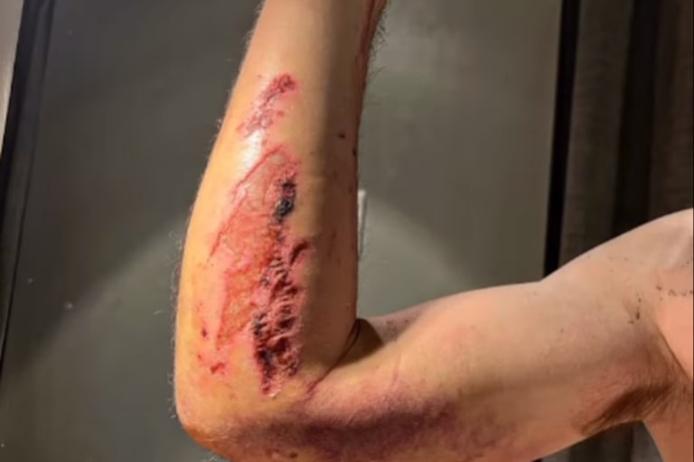 So sah der rechte Unterarm von Eugene Laverty nach dem Assen-Sturz aus