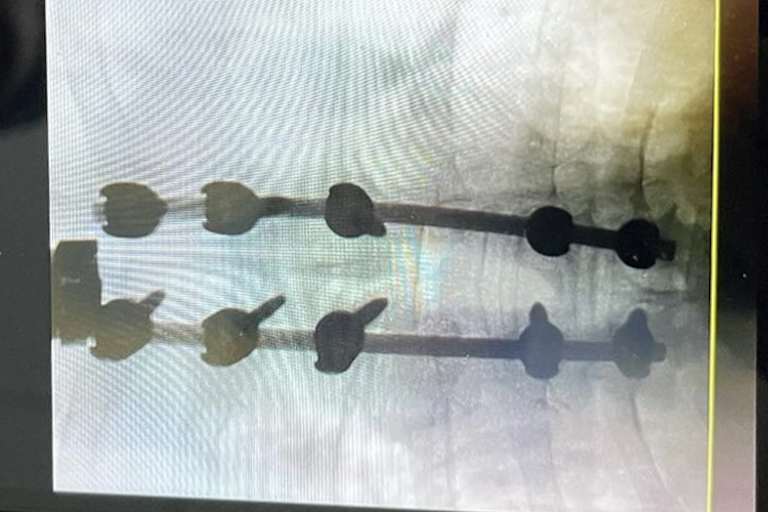 Die Wirbelsäule wurde stabilisiert