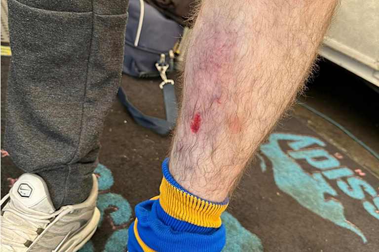 Abschürfungen und Blutrgüsse werden Cassidy noch länger an seinen Unfall erinnern