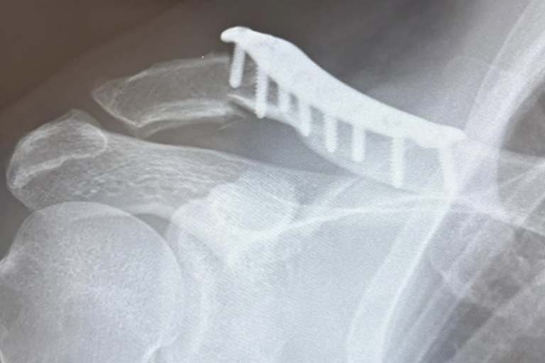 Diese Platte wurde eingesetzt