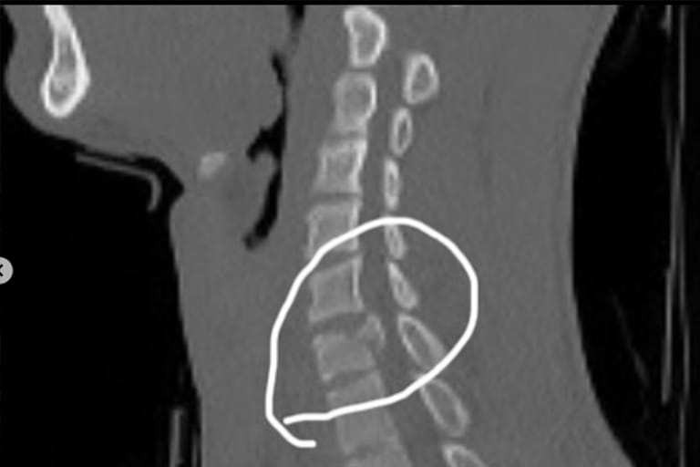 In der Röntgenaufnahme ist der Wirbelbruch deutlich zu erkennen