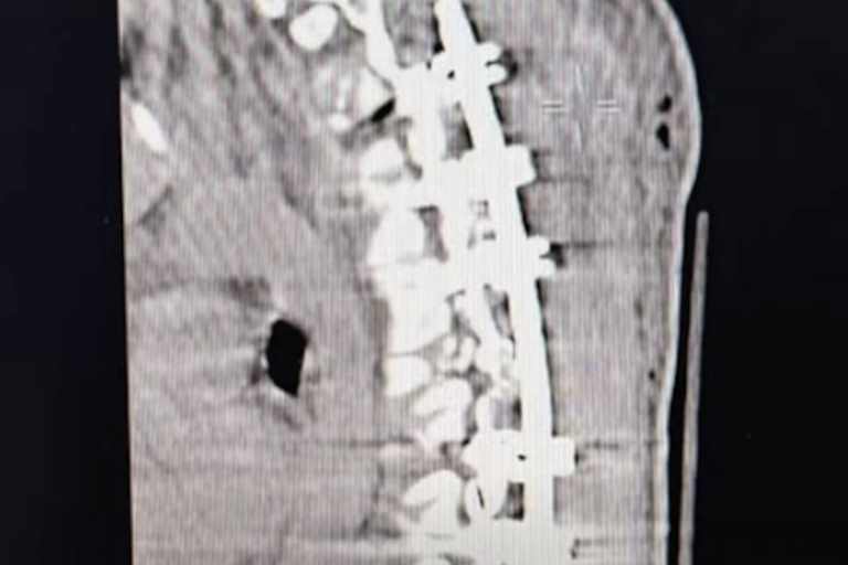 Die Wirbelsäule von Jerry Robin wurde stabilisiert