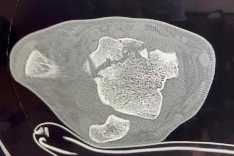 Der Bruch im Knöchelbereich ist massiv