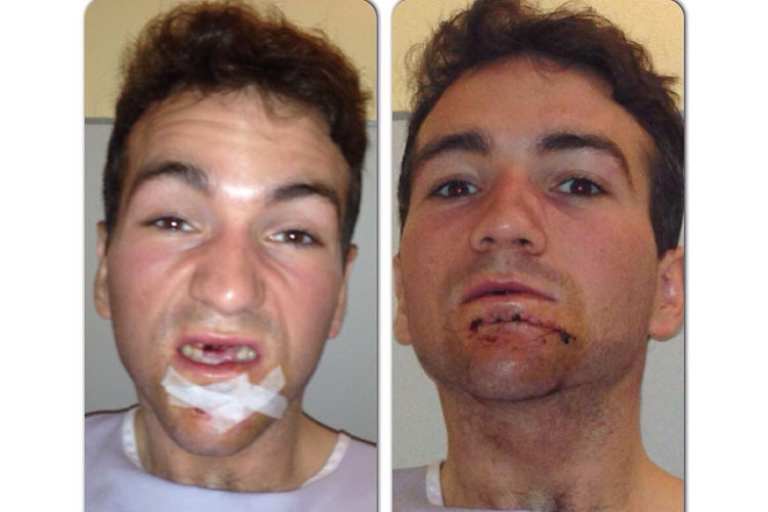 Xavier Siméon: So sah der Belgier vor und nach der Operation in Almeria aus